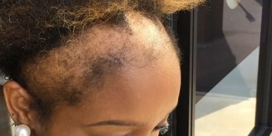 10 Best Herbal Remedies for Alopecia: Natural Solutions for Hair Loss