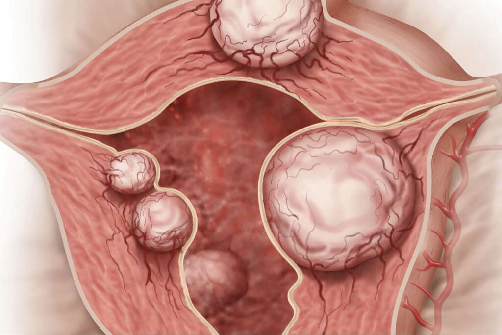 Healing Fibroids with Herbs: 5 Natural Remedies for Black Women